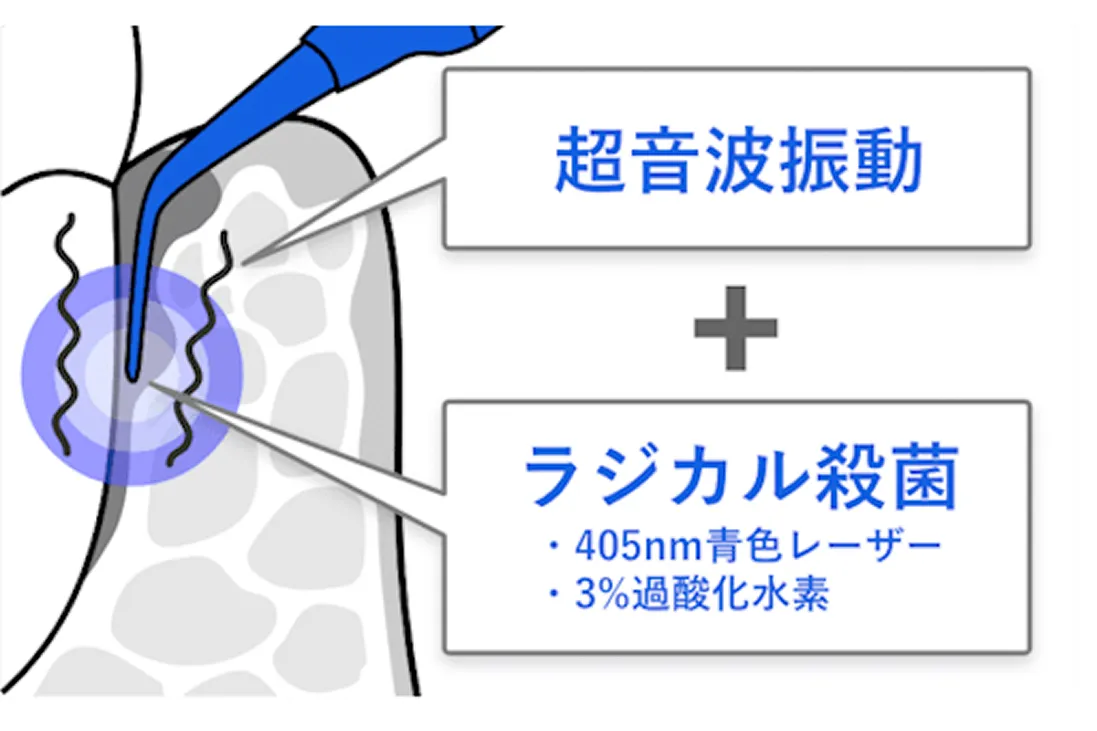 ブルーラジカル